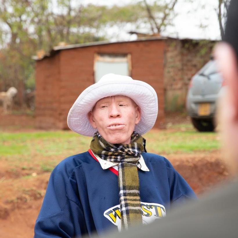 A man with albinism wearing a white wide-brim sun hat.