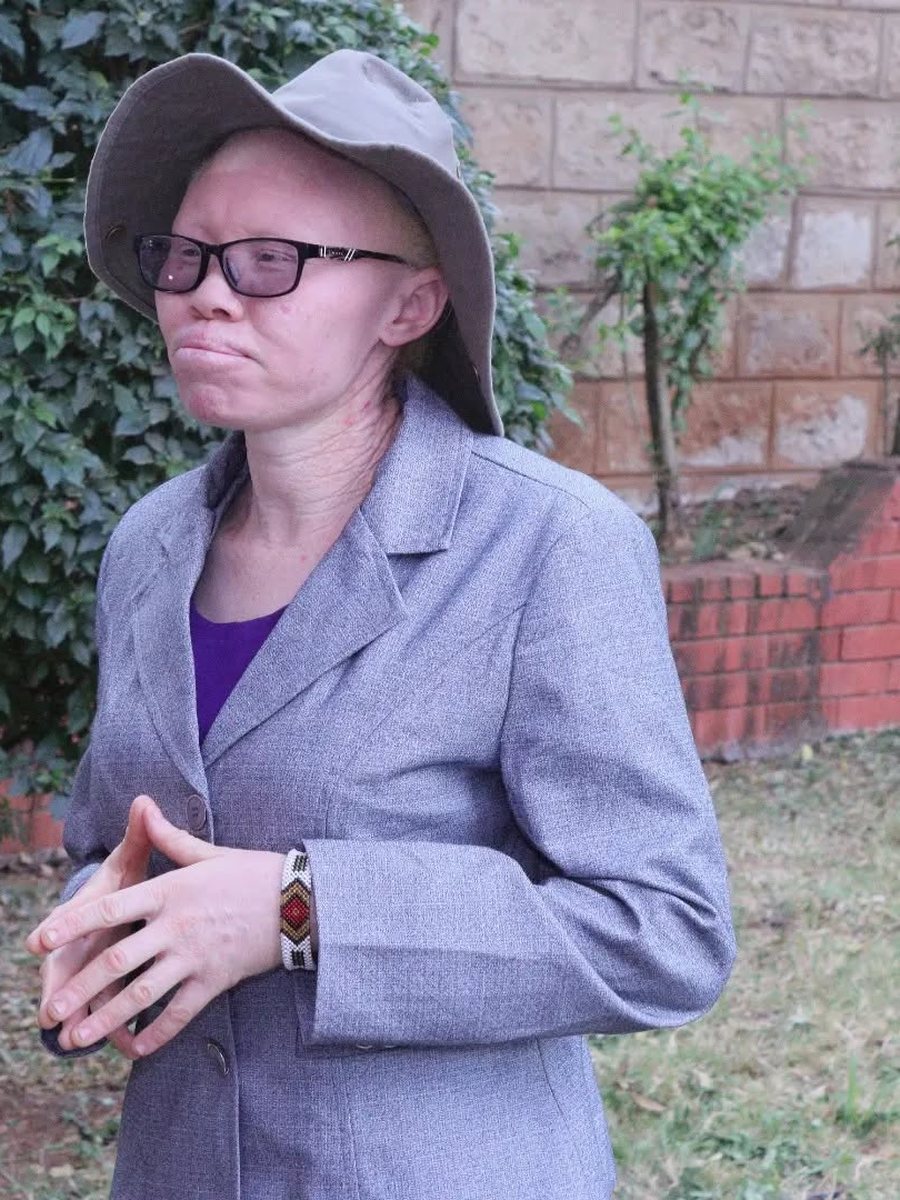 Zippie Ntinini, Kajiado County at Black Albinism.